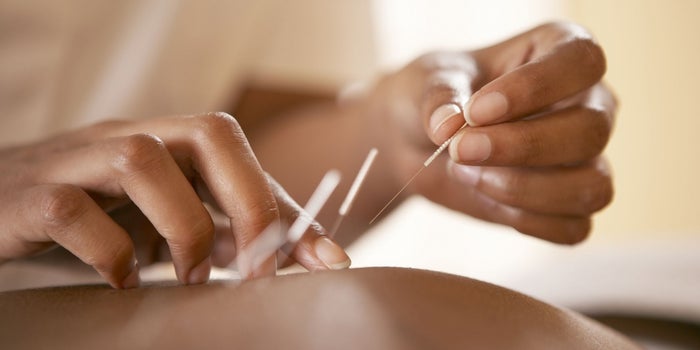 Modern Acupuncture Showing Signs of Huge Growth