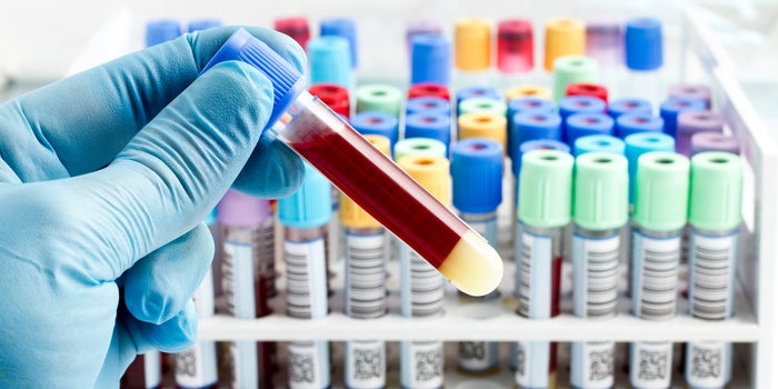 El tipo de sangre podría ser un factor que determina el agravamiento respiratorio en un paciente con COVID-19